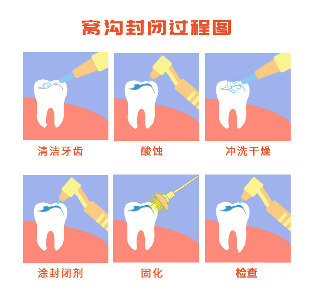 儿童窝沟封闭过程图