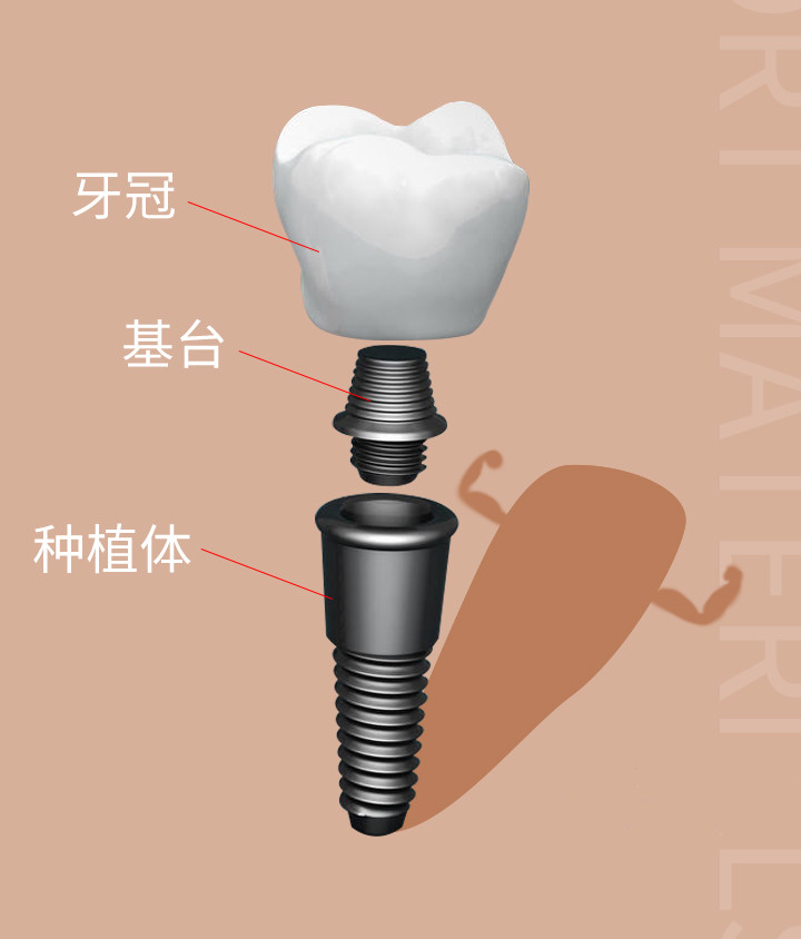 一颗种植牙的构成