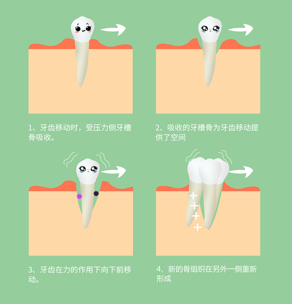 牙齿矫正历程