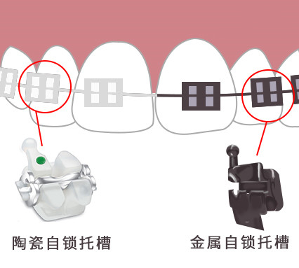 自锁托槽矫正牙齿